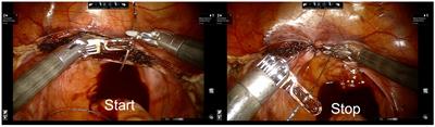 Novel workflow analysis of robot-assisted hysterectomy through objective performance indicators: a pilot study